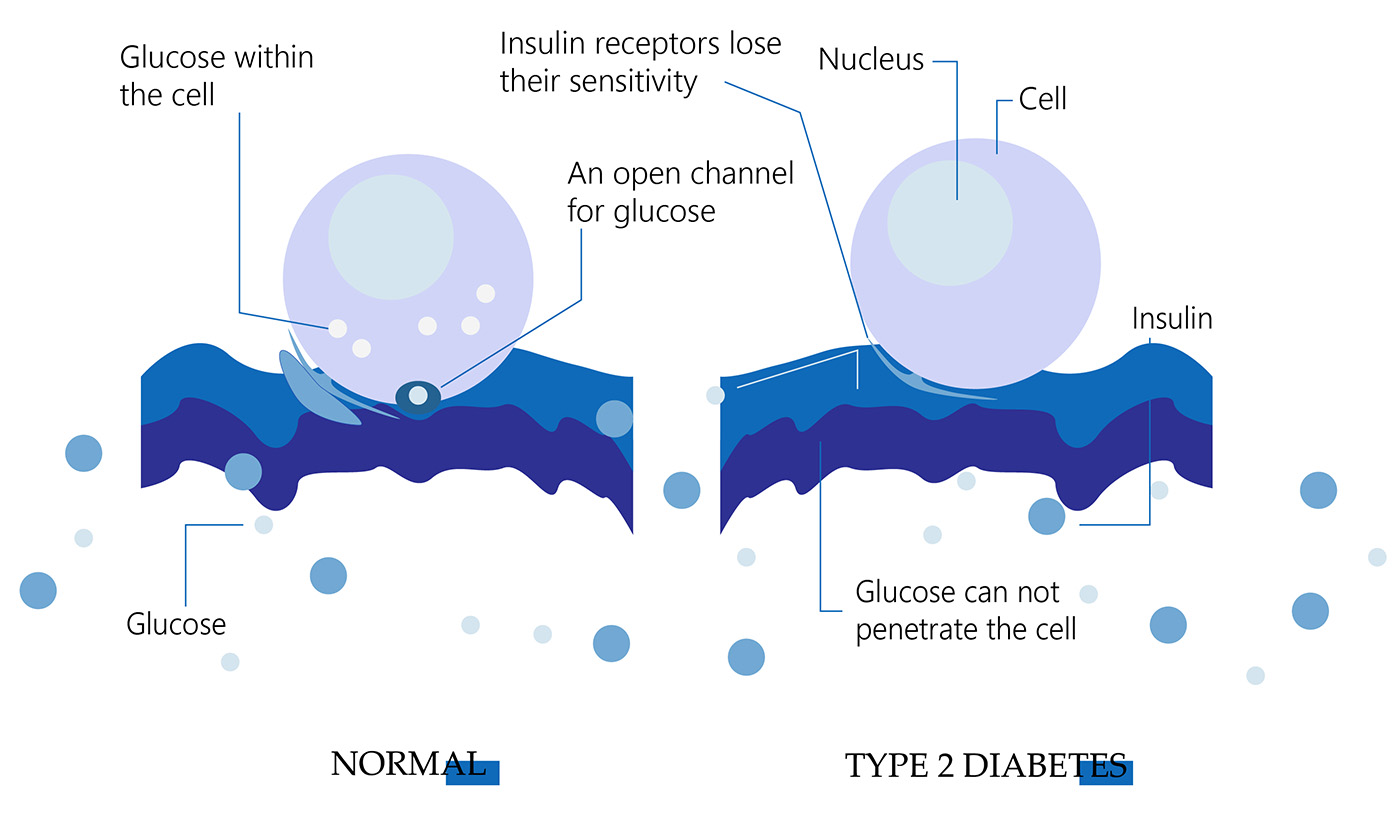 type 2 diabetes betagenon type 2 diabetes betagenon